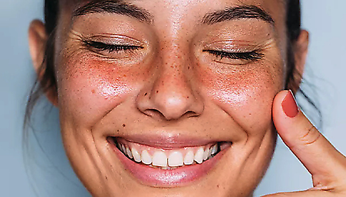 Rosacea: fenotypy, spúšťače a starostlivosť 